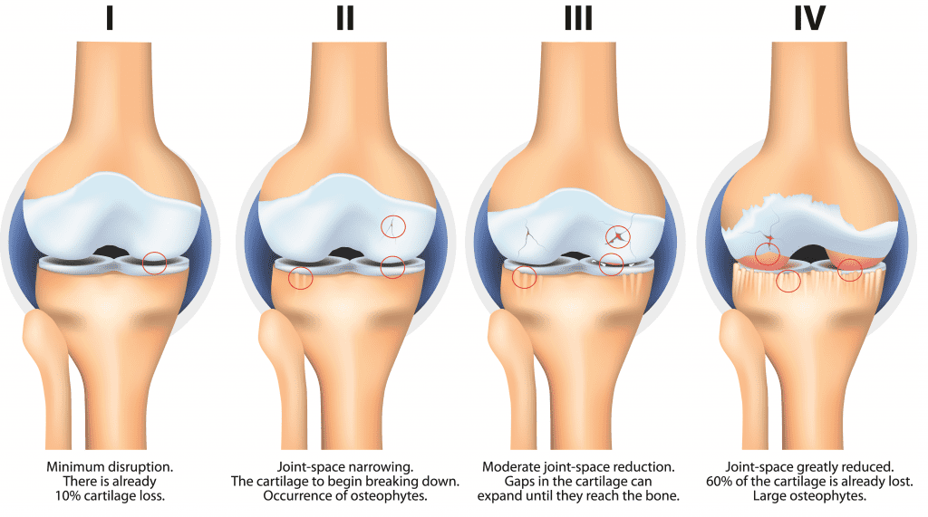 Stages of Osteoarthritis